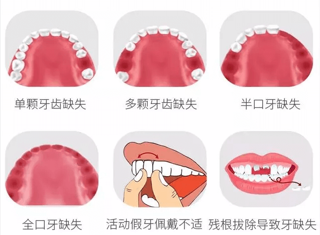 佳德口腔种植牙
