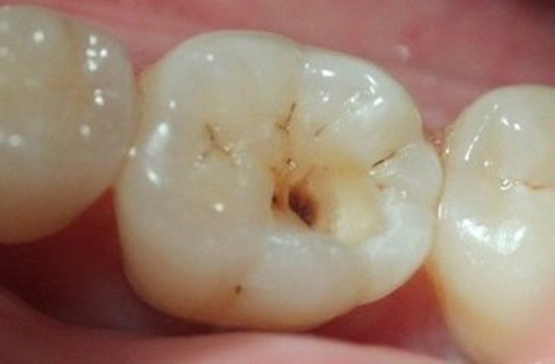 佳德口腔补牙
